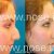 Nose Plastic Surgery by Dr. Mohsen Naraghi